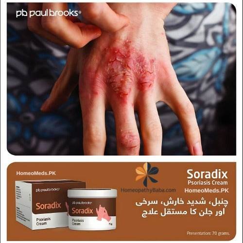 Paul Brooks Soradix Cream for psoriasis symptoms and scaly patches | HomeopathyBaba.com
