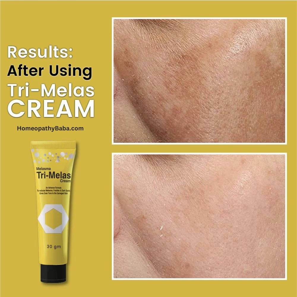 Tri Melas Cream by Dr Romia - HomeopathyBaba.Com